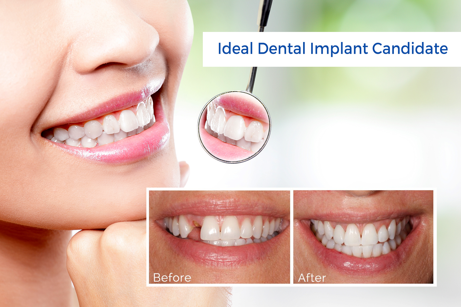 Does Your Dentist Suggest To Perform Dental Implants?