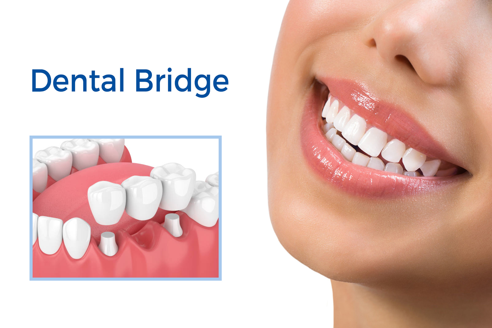 Reasons why dental implant bridges are better than dentures
