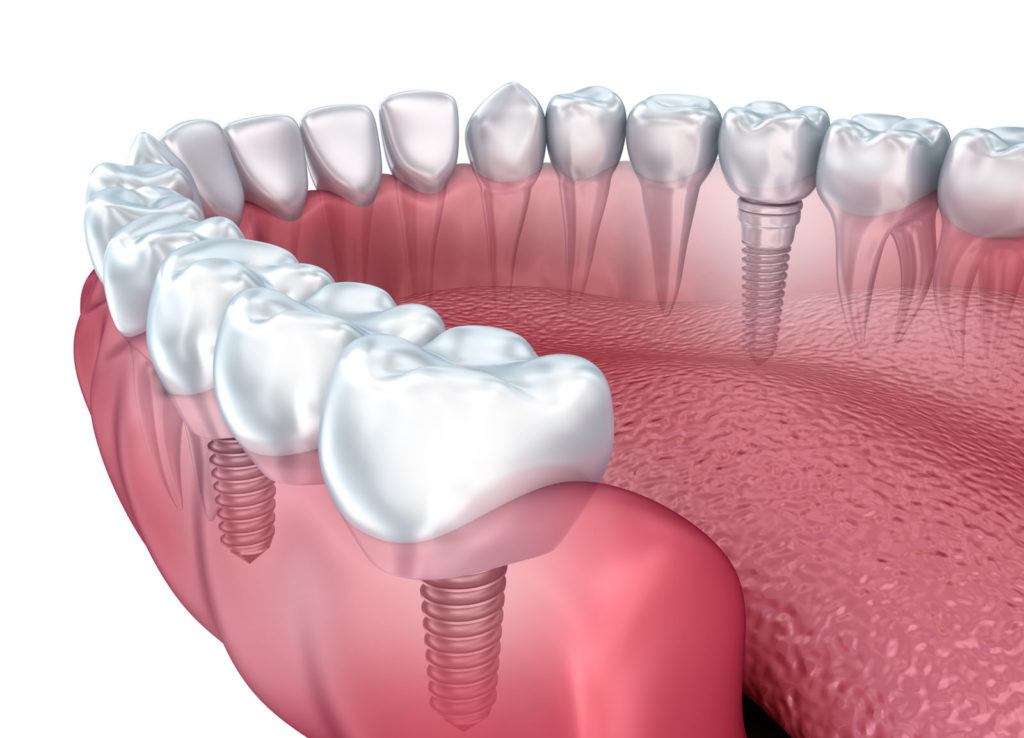 Dental Bridge vs. Implant: What’s the Best Approach to Replace a Tooth?